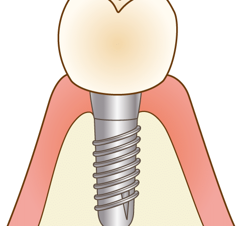 インプラントのイラスト