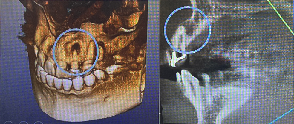 歯科用CT画像