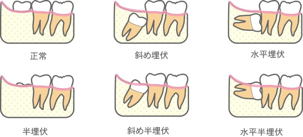 親知らずの生え方の種類